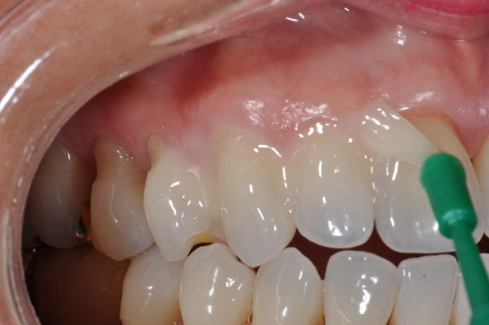 Что такое клиновидный дефект зубов?