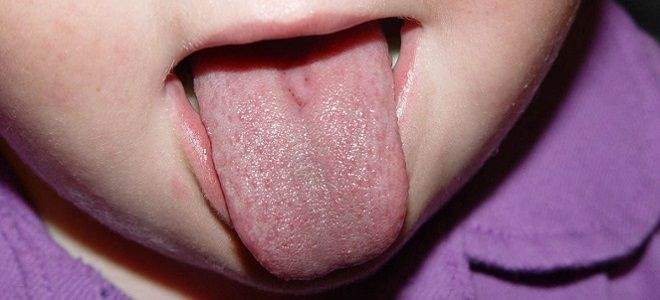 Почему появляется налет на языке у ребенка?