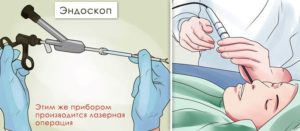 Как проводится эндоскопическая гайморотомия