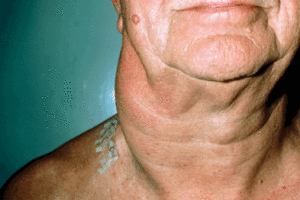лимфаденопатия на шее