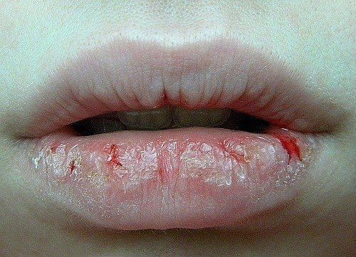 6 лайфхаков быстро помогут убрать трещинки на губах