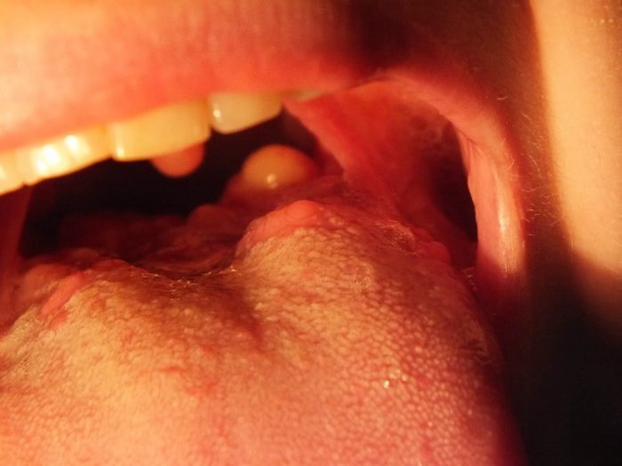 Болит корень языка: какие болезни могут вызывать боли?
