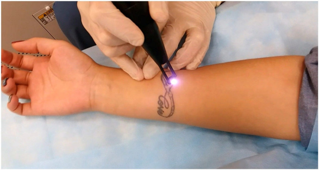 сведение татуировки лазером