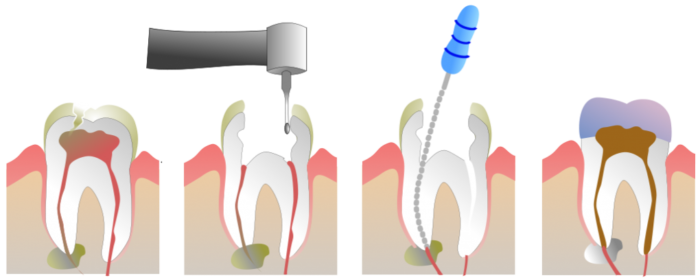 Удаление пульпы зуба