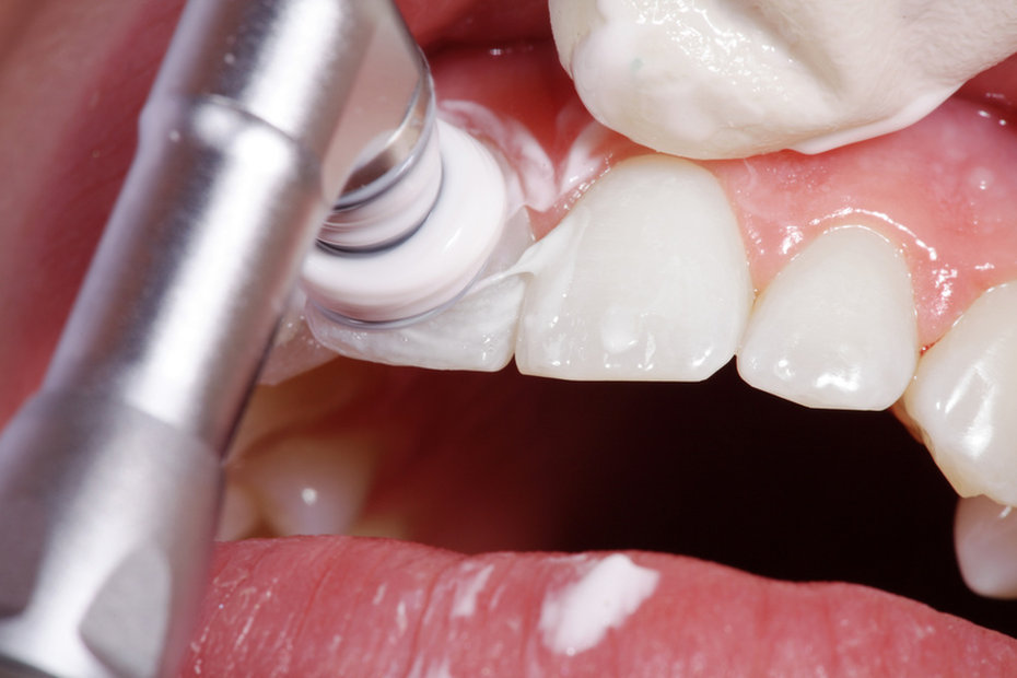 Особенности проведения полировки зубов