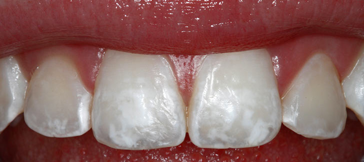 Белый сгусток после удаления зуба фото