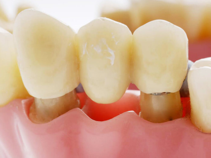 Что такое зубной мост?